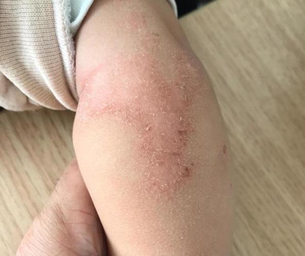 宝宝湿疹起皮怎么回事