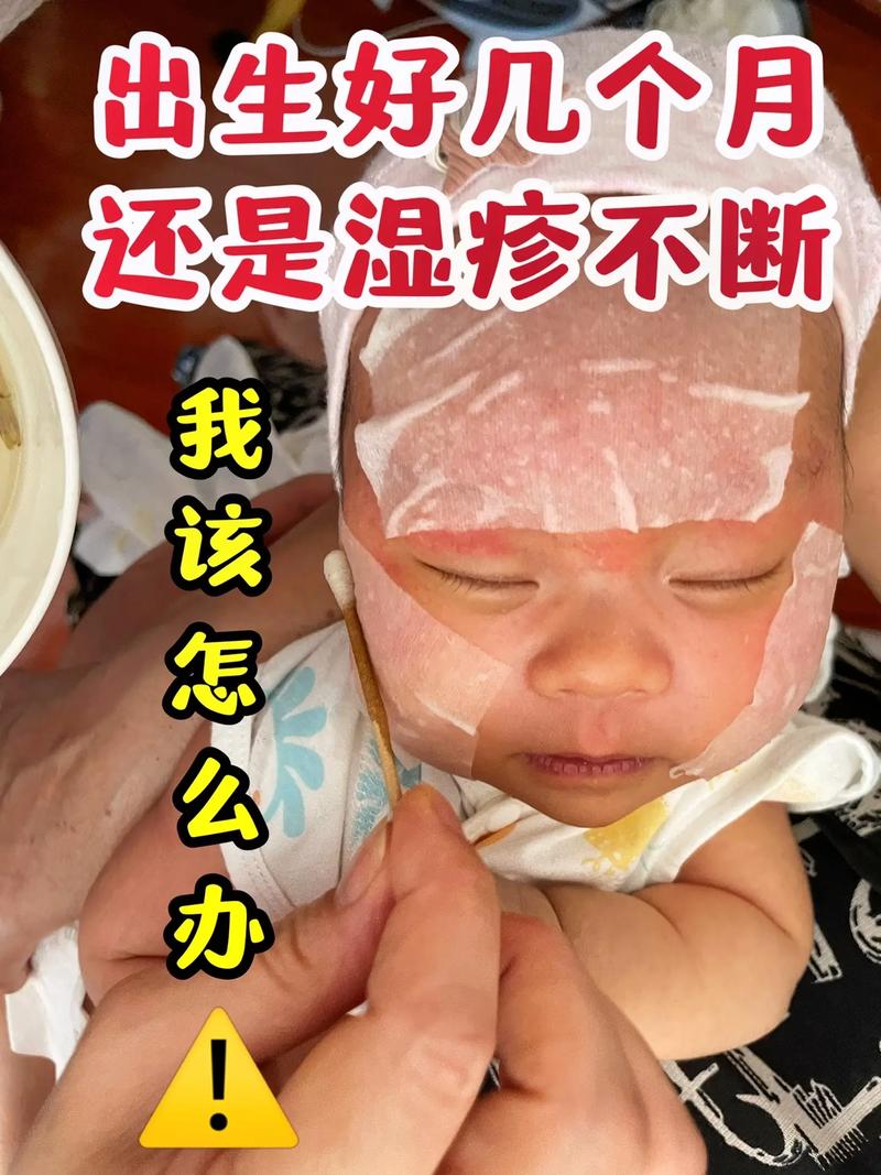 二个月宝宝湿疹怎么办