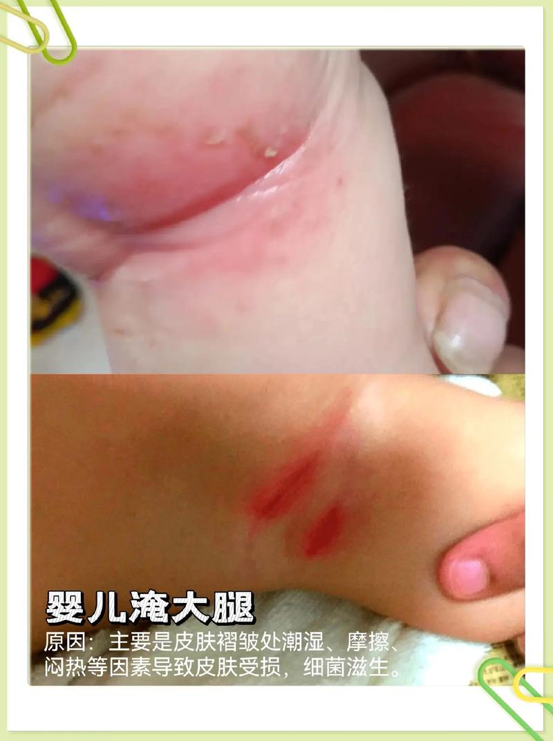 宝宝腿淹了破皮怎么办