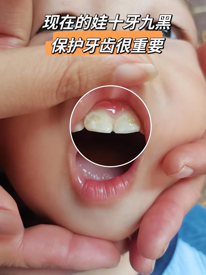 宝宝牙齿缺口怎么回事