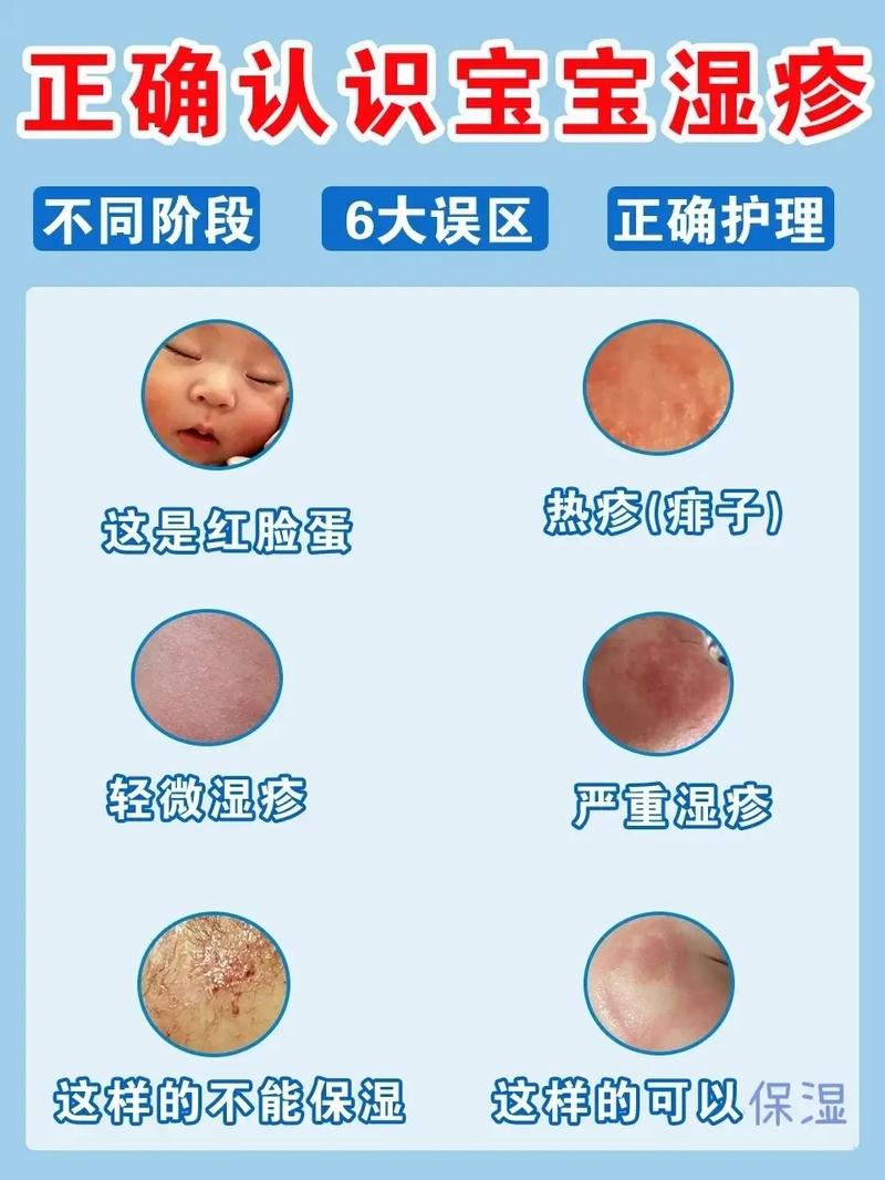 小宝宝的湿疹怎么办啊